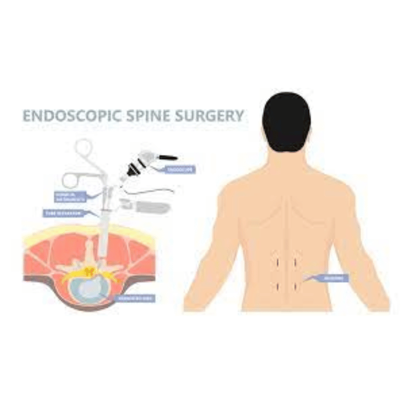 endoscopic discectomy procedure